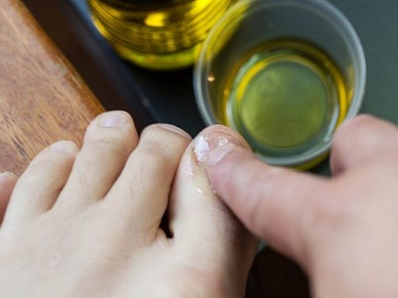 aceite de árbol de té para hongos en las uñas de los pies
