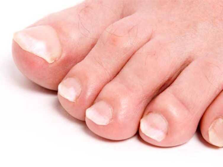 hongos en las uñas de los pies y su tratamiento