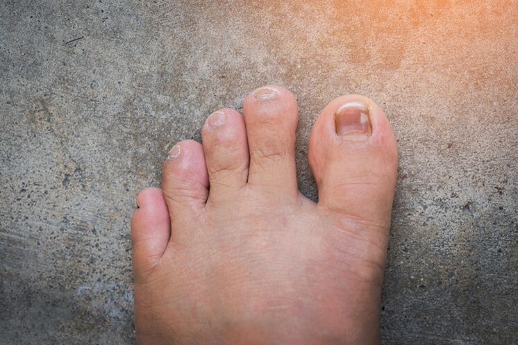 Hongo de uñas
