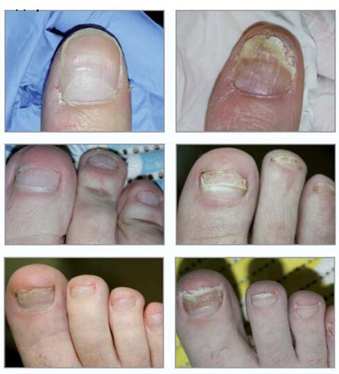 Tipos de hongos de uñas