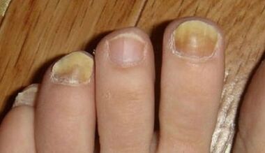 Las causas de la aparición del hongo en las uñas