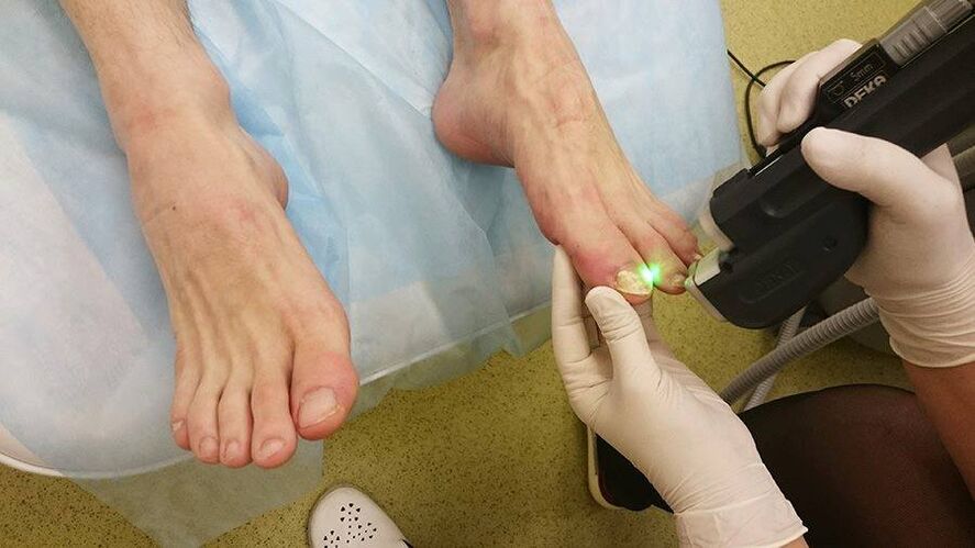 tratamiento con láser de hongos en las uñas de los pies