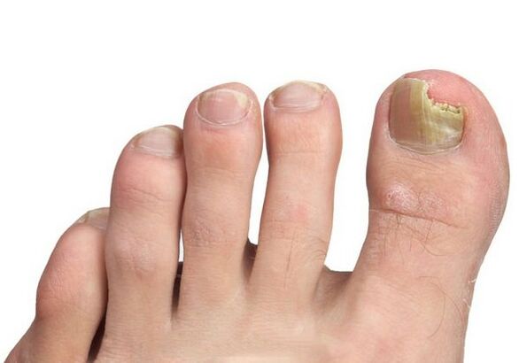 Causas de hongos de uñas