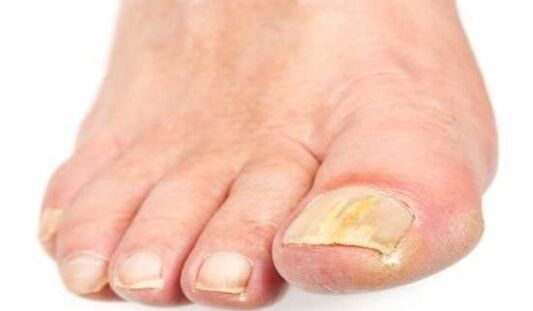 Coloración amarillenta de las uñas debido a una infección por hongos.