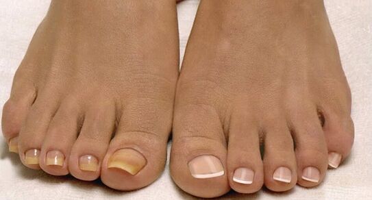 uñas normales y hongos en las uñas de los pies