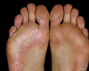 lesión de los pies con hongos