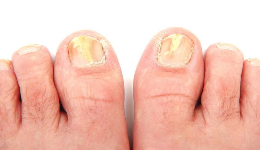 hongos en las uñas de los pies
