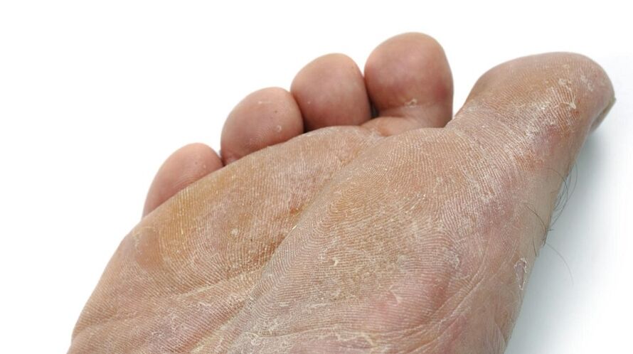 síntomas de hongos en los pies