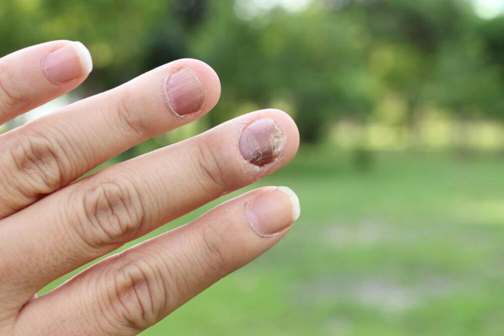 hongos en las uñas
