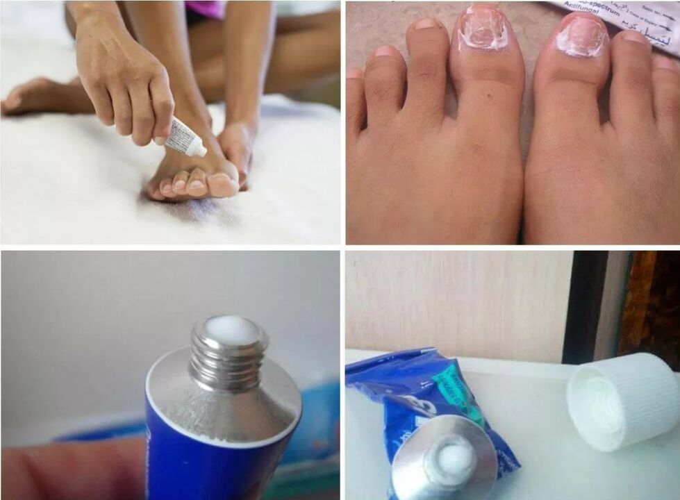 medicamento para hongos en las uñas de los pies