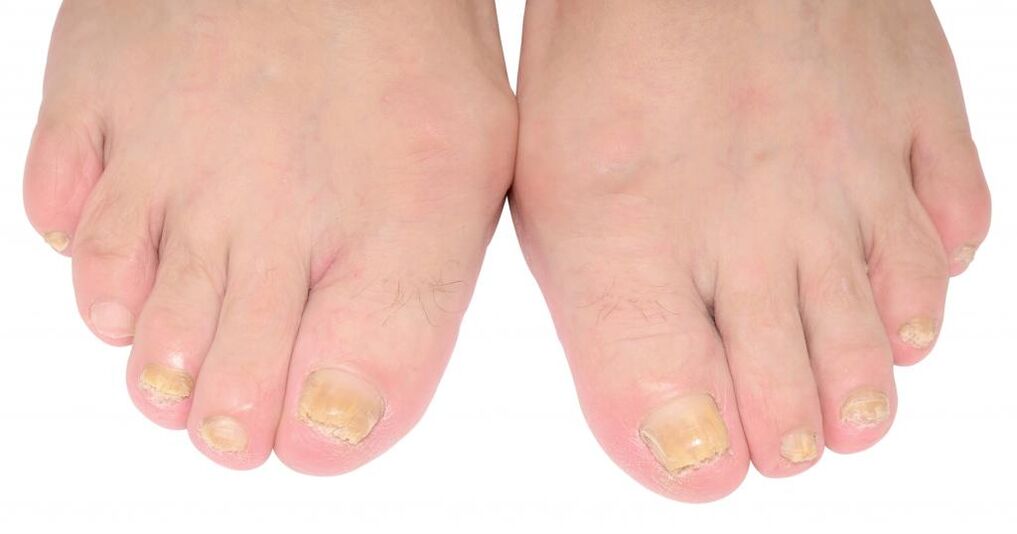 signos de hongos en las uñas de los pies