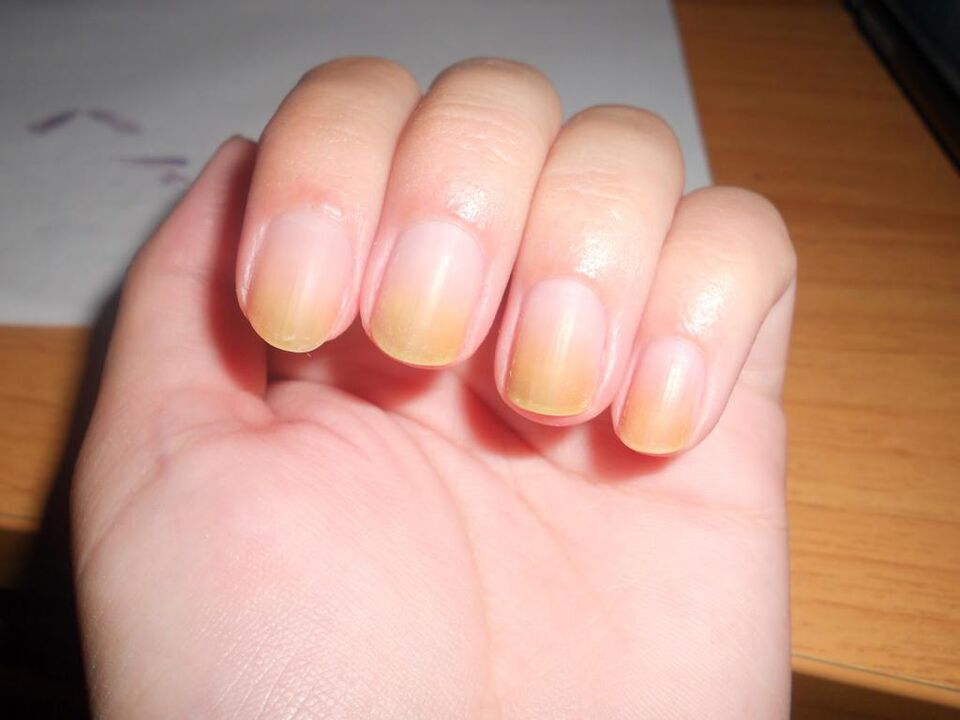síntomas de hongos en las uñas