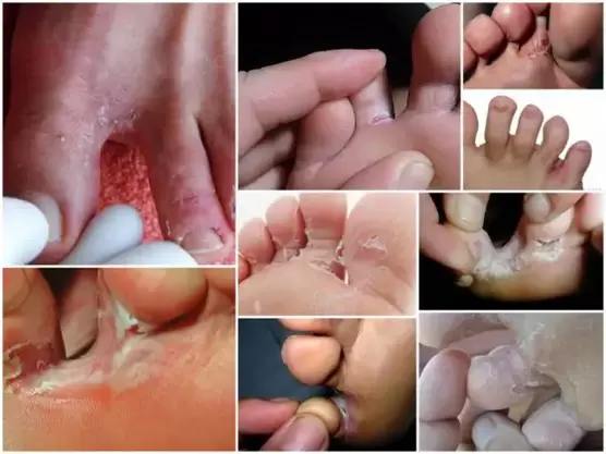 síntomas de hongos entre los dedos de los pies foto 2