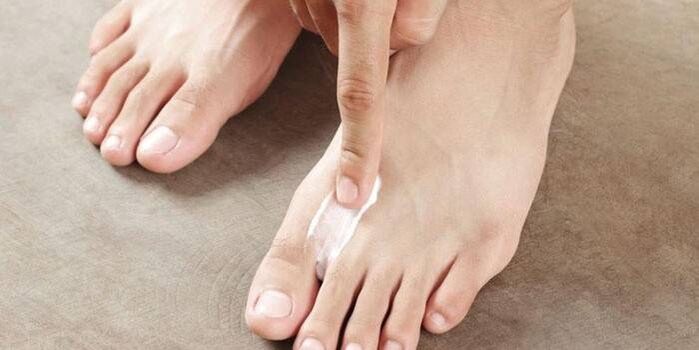 ungüento para el tratamiento de hongos entre los dedos de los pies