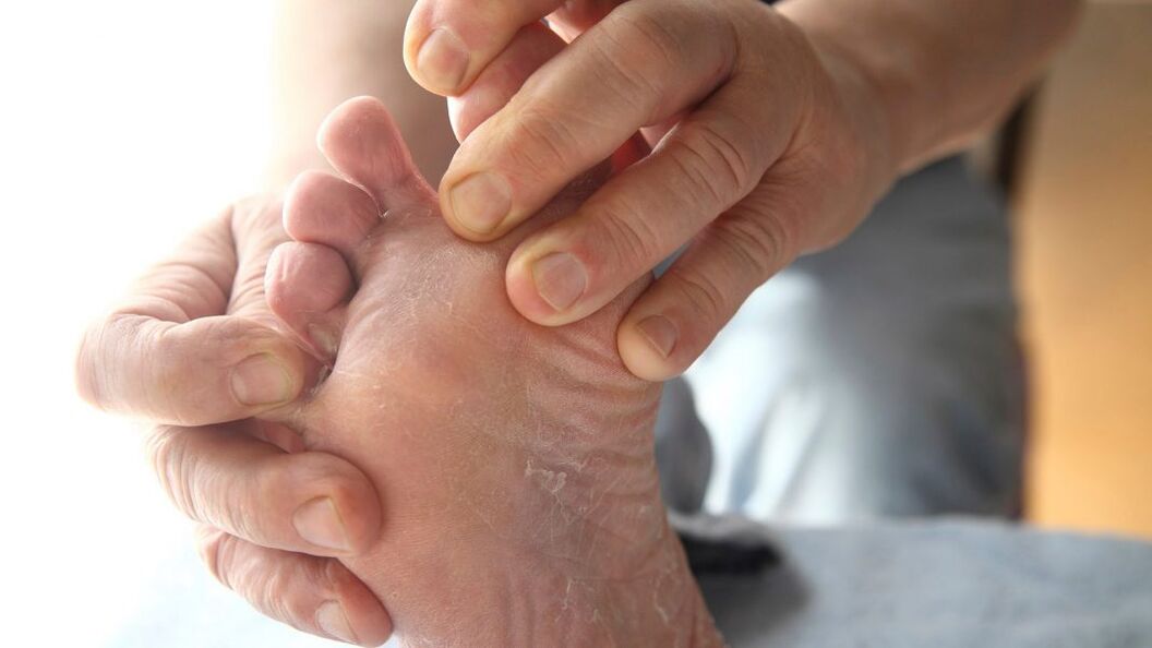 síntomas de hongos en los pies