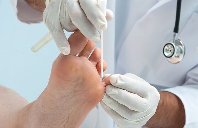 diagnóstico de hongos en las uñas de los pies