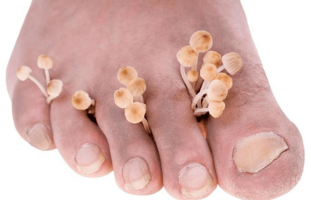 Infección por hongos en los pies