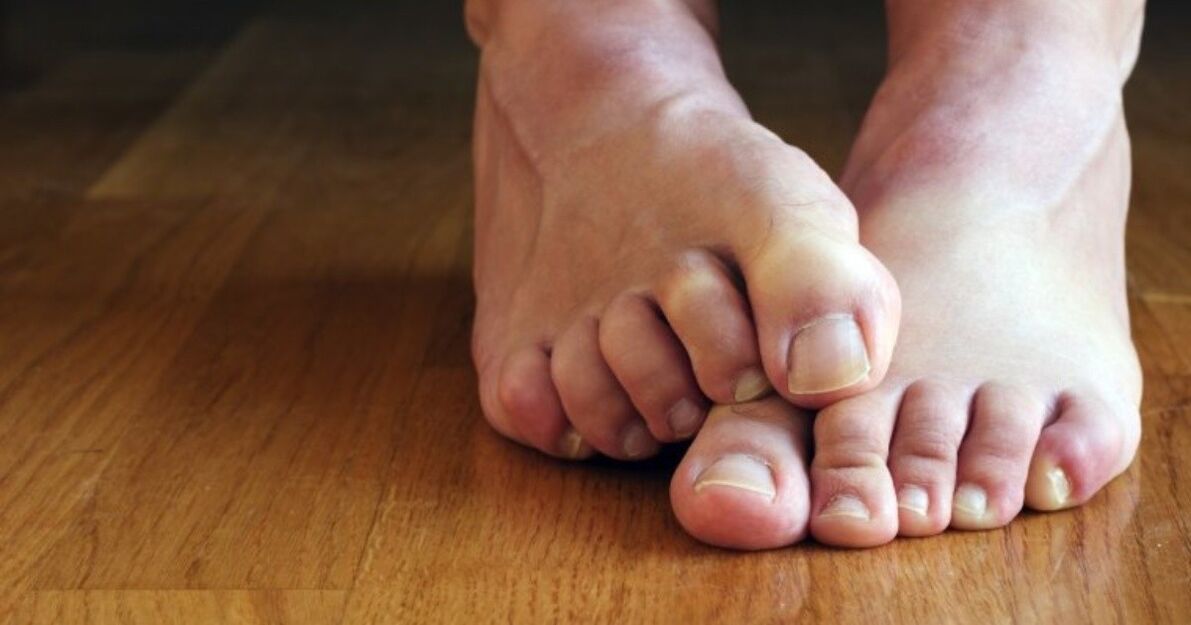 síntomas de hongos entre los dedos de los pies